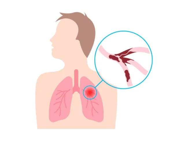 Emfizemul pulmonar