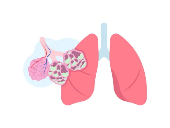 Fibroza chistică: cauze, simptome și management