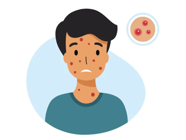 Rujeola: o boală contagioasă care poate fi prevenită