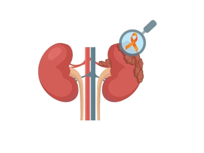 cancer la rinichi, tumoare la rinichi, cancer renal durata de viata, cancer rinichi, cancer renal, cancer la rinichi simptome, tumora rinichi, cancer la rinichi cu metastaze, cancer renal simptome, tumora la rinichi, tumoare rinichi, cancer rinichi simptome, tumora rinichi benigna, cancer de rinichi, cancerul renal, tumora renala, tumoare renala, tumori renale, simptome cancer renal, cancerul de rinichi, simptome rinichi bolnavi, tumora sau chist pe rinichi, biopsie rinichi, chist pe rinichi...