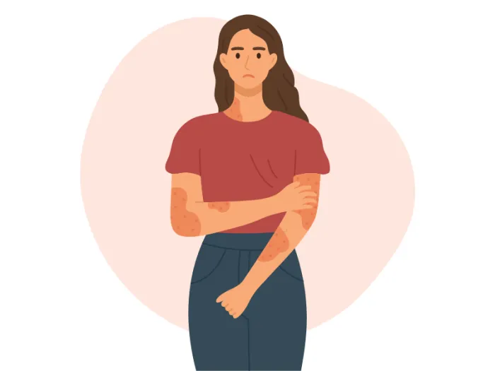 dermatita, ce este dermatita, dermatita atopica, dermatita atopica bebelusi, eczema, eczema piele, dermatita, ce este dermatita