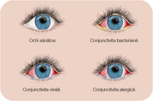 conjunctivita alergica, tratament conjunctivita alergica, alergie la ochi, mancarime ochi, alergie ochi