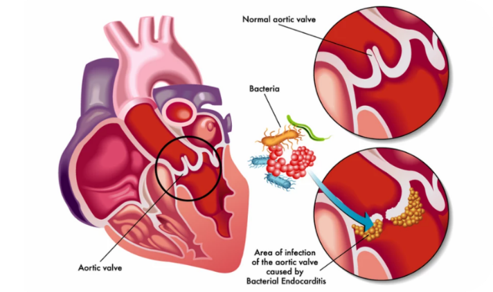 endocardita, endocard, endocardita infectioasa, endocardita bacteriana, endocardita stafilococica