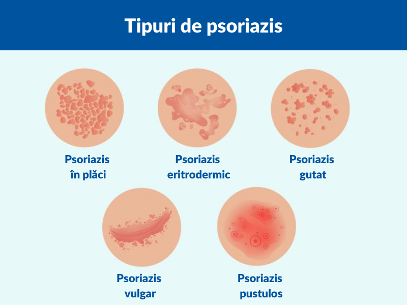 psoriazis, ce este psoriazis, psoriazis tratament, psoriazis cauze, psoriazis poze, psoriazis scalp