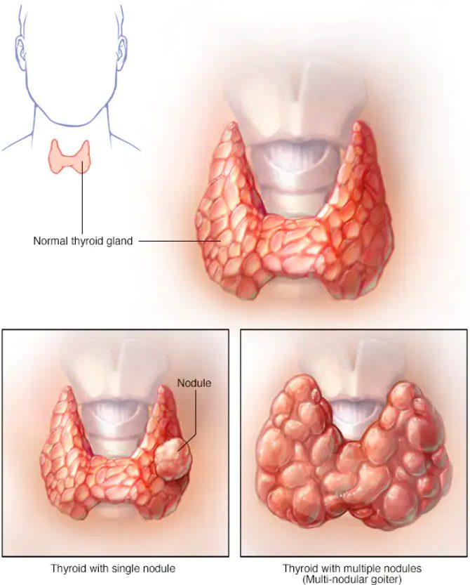 gusa, gusa endemica, ce este gusa, gusa tiroidiana, gusa nodulara, gusa micronodulara, gusa multinodulara netoxica
