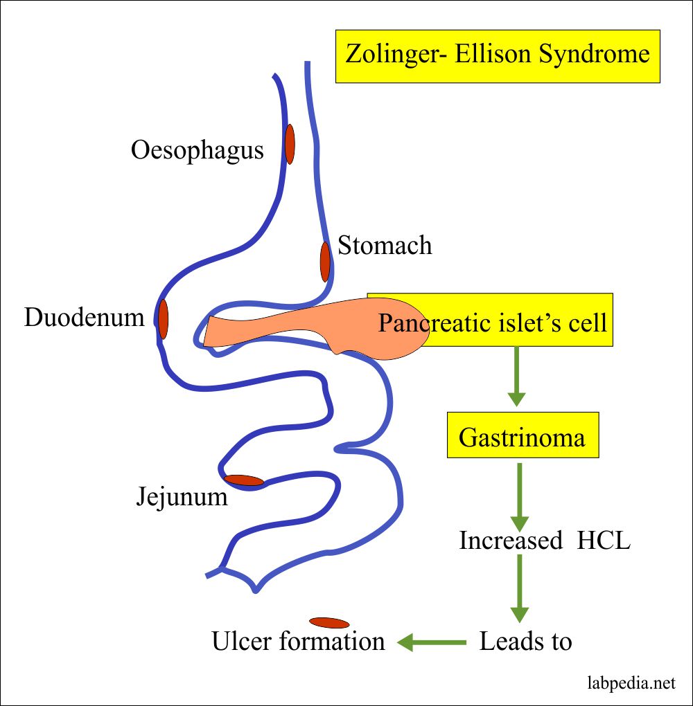 sidrom zollinger ellison, Zollinger Ellison, gastrina
