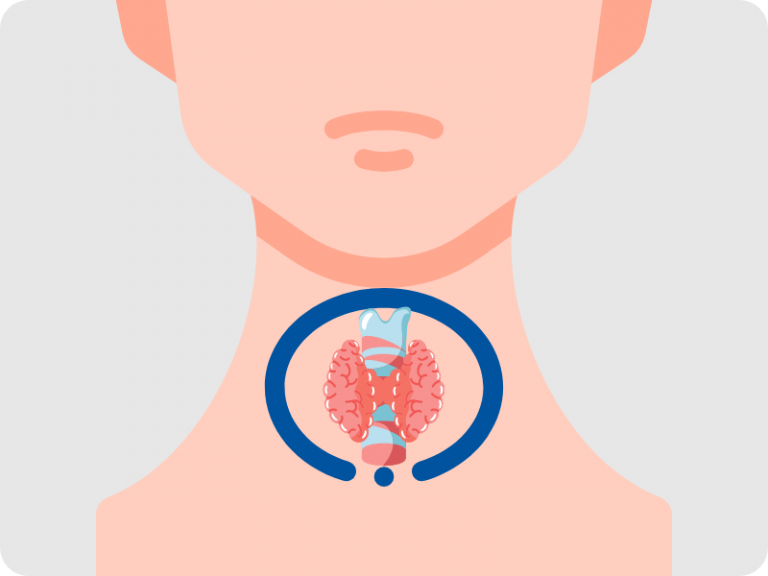 cancer tiroidian, cancerul tiroidian, iodura de potasiu, noduli tiroidieni, tumora maligna