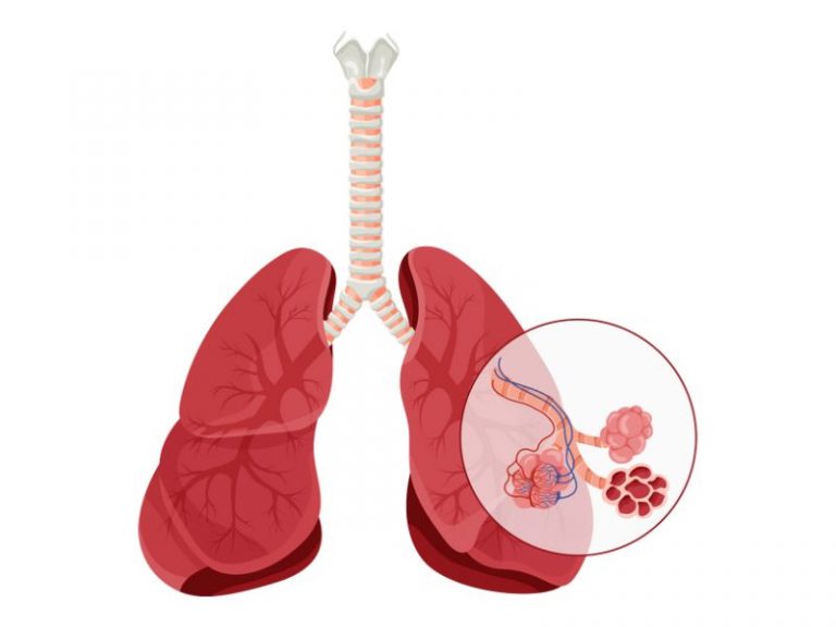 edem pulmonar, soc septic, edem pulmonar acut, bronhodilatatoare, alveole pulmonare, infarctul pulmonar, ventilatia pulmonara