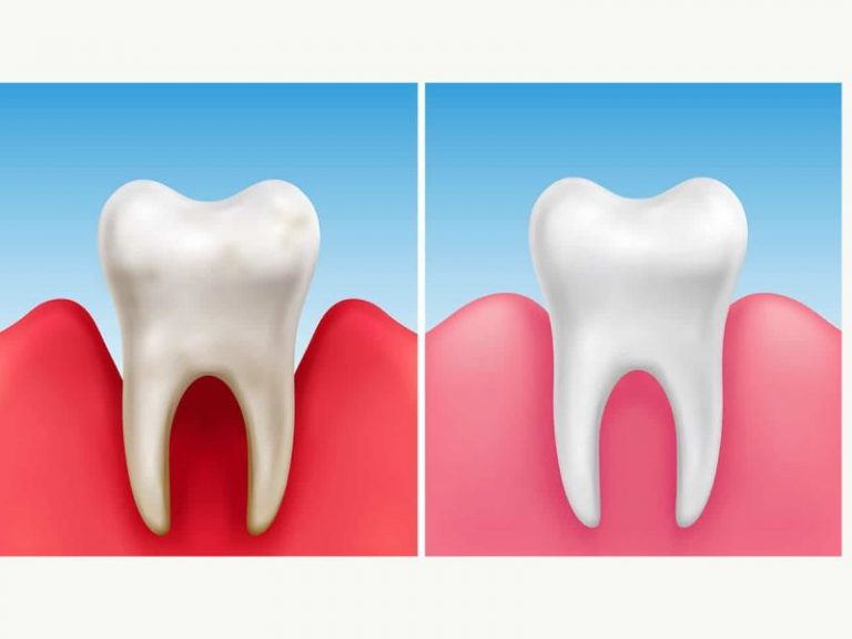 parodontoza, parodontita, tratament parodontoza, inflamarea gingiilor, parodontoza simptome