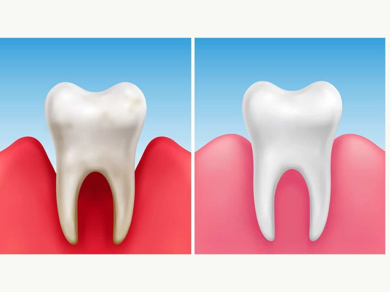 parodontoza, parodontita, tratament parodontoza, inflamarea gingiilor, parodontoza simptome